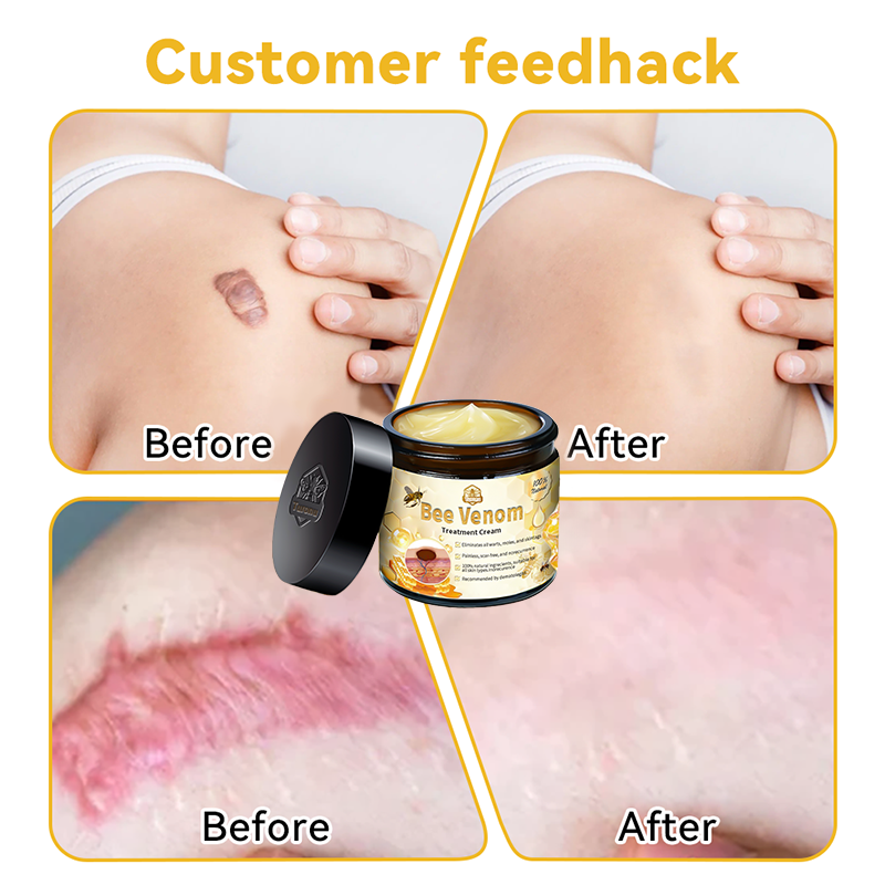 Turonu™ Bee Venom Skin Cream is approved by the Irish Association of Dermatology (IAD) (helps treat acne, warts, rosacea, psoriasis, age spots, eczema and reduces the appearance of stretch marks)🌿