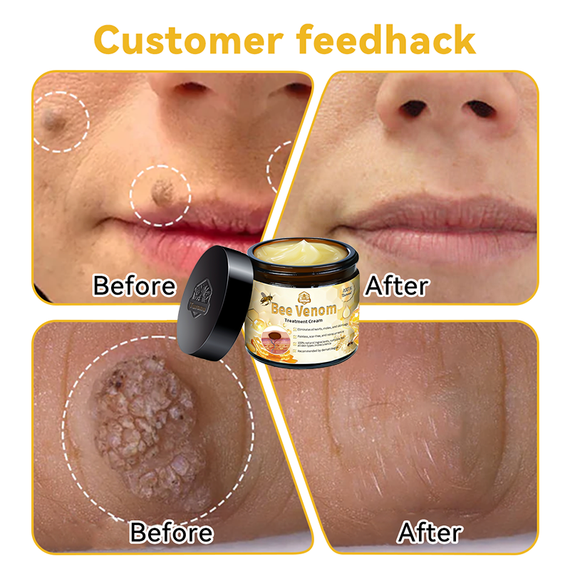 Turonu™ Bee Venom Skin Cream is approved by the Irish Association of Dermatology (IAD) (helps treat acne, warts, rosacea, psoriasis, age spots, eczema and reduces the appearance of stretch marks)🌿